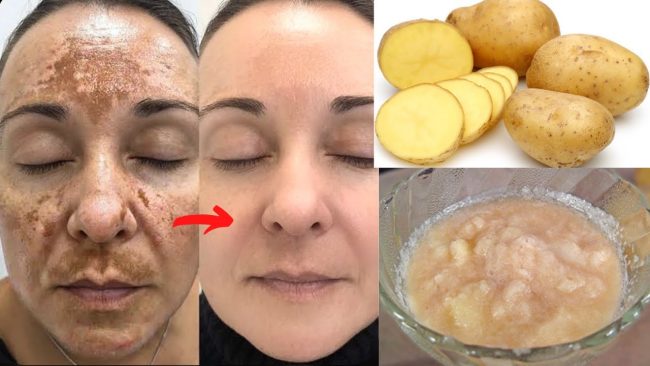 Pigmentation Remove: पिगमेंटशन से हो गया है चेहरा काला, लगाएं आलू और कॉफी का फेस मास्क, लौट आएगी रंगत